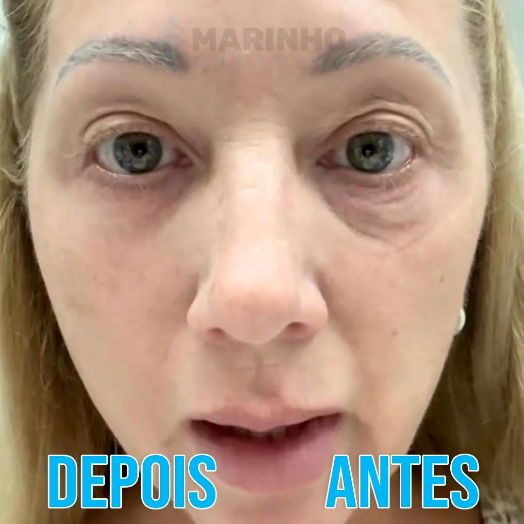 Creme Antirrugas Instantâneo DermaSkin - Image 4