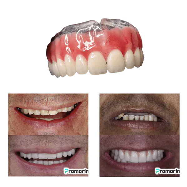 Dentadura de Silicone FIX | Ajustavel e Adaptativa - Image 5