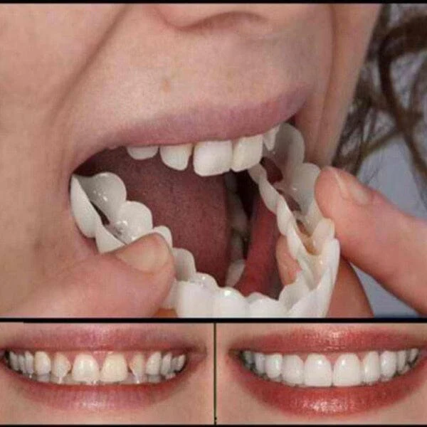 Lente de Contato Dental Removível Inferior e Superior - Image 7