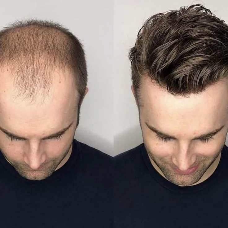 Prótese Capilar Masculina - NewHair - Image 2